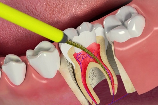 endodontiya_1