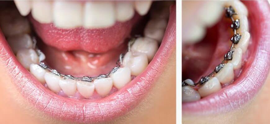 vstanovlennya-lingvalnyh-breketiv_1