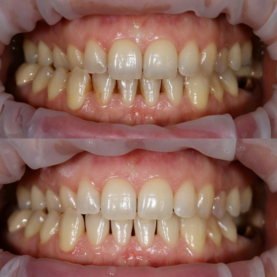 chyshhennya-zubiv-vid-kariyesu_1