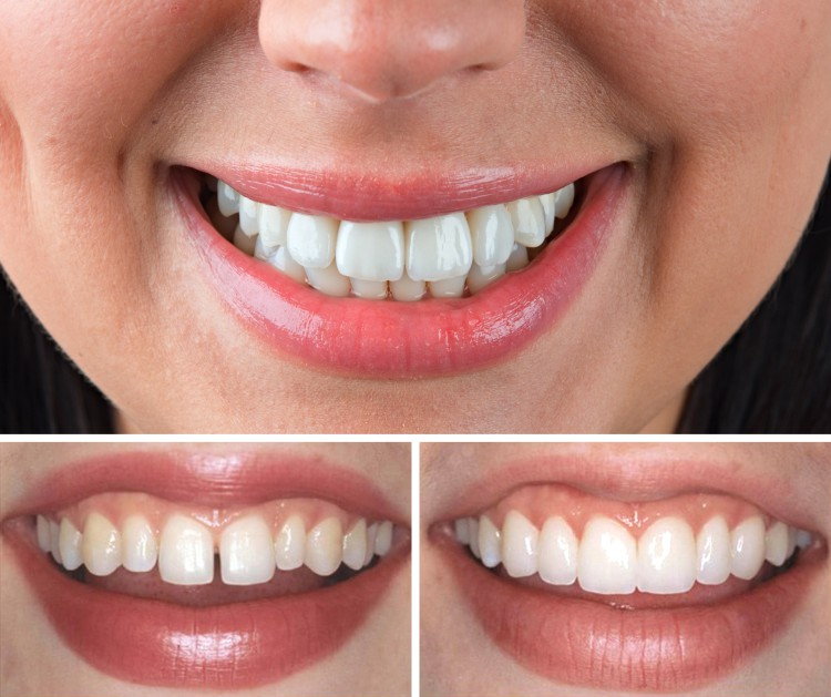 plombuvannya-zubiv-cherkasi_1