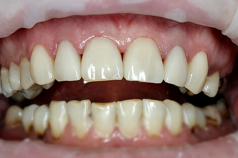 kariyes-perednih-zubiv_2