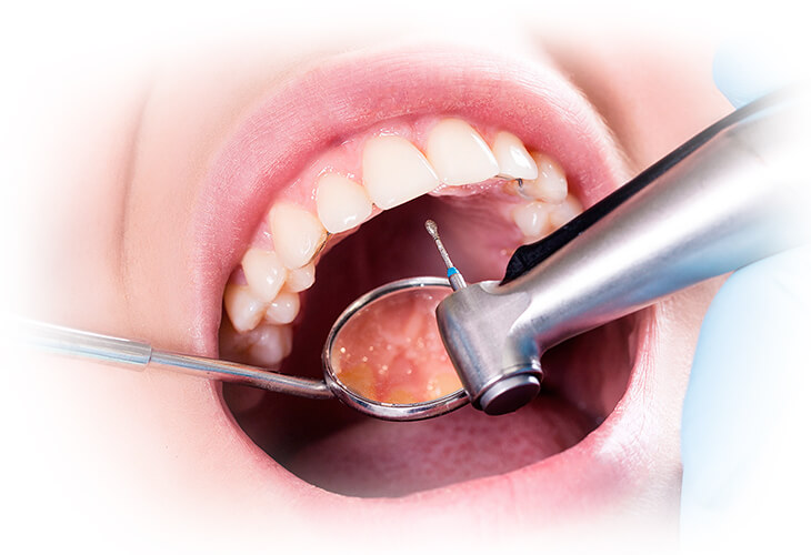 likuvannya-kariyesu_2