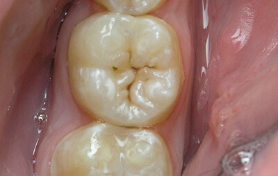 poverhnevyj-kariyes_1