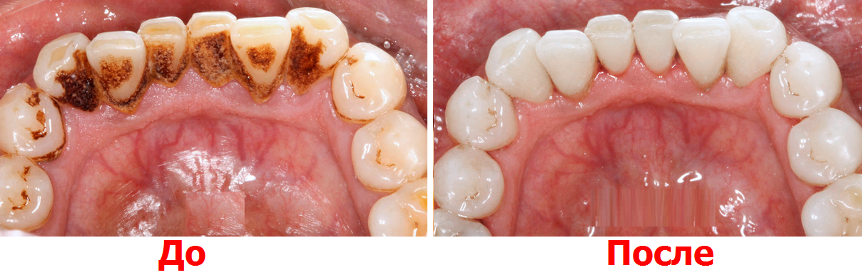 profesijna-gigiyenichna-chystka-zubiv-u-cherkasah_2