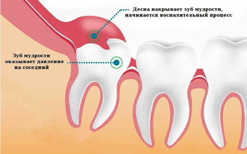 vydalennya-zuba-mudrosti_3