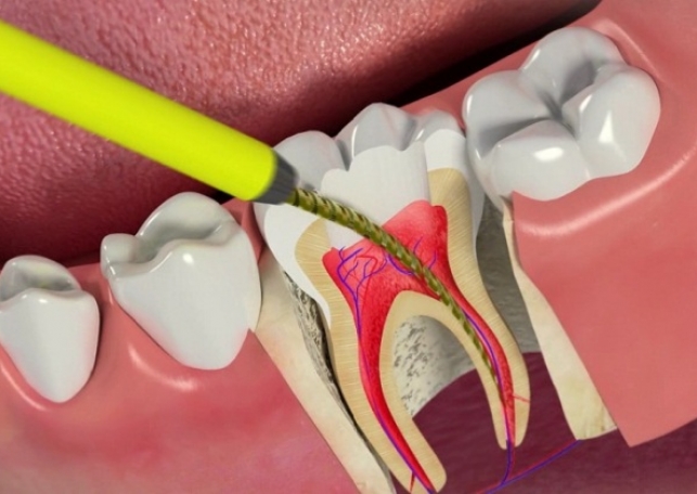 endodontiya_3