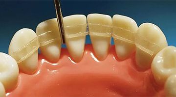 shynuvannya-zubiv-sklovoloknom_2