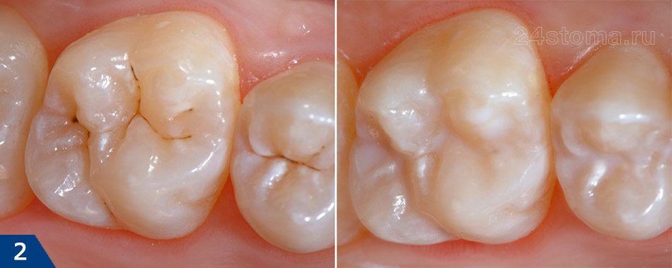 germetyzacziya-fisur-u-ditej_4