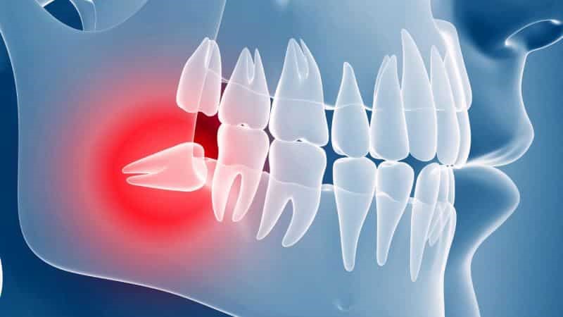 vartist-vydalennya-zuba-mudrosti_1